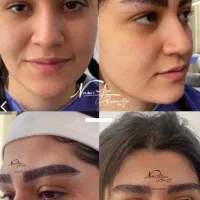 کاشت ابرو/با شرایط اقساط