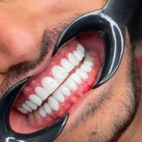 کامپوزیت دندان بابهترین کیفیت دریک جلسه از فکی15