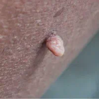 درمان خال گوشتی یاHPV زگ.یل