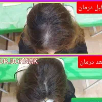 درمان تخصصی انواع ریزش مو و رویش مجدد در خانمها