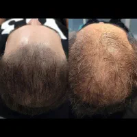 میکرو،فیبروز،شیدلب،اسکالپ،لیفت