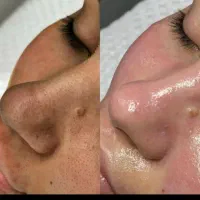لیزر موهای زاید،پاکسازی و فشیال پوست