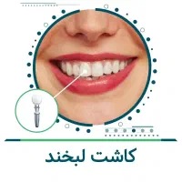بازسازی فک با اوردنچر