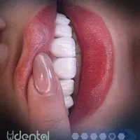 ایمپلنت لمینت کامپوزیت اقساط ویژه