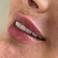 مدل جهت تزریق فیلر لب