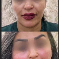 چربی صورت