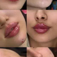 فیلر لب روسی .عروسکی .