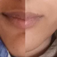 پکیچ پوست برای انواع مشکلات پوستی