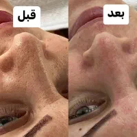 خال برداری،نیدل،اسید تراپی،رفع لک و جوش