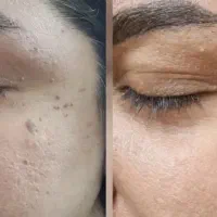 زگیل ، خال ، منگوله. مقعد ، تبخال