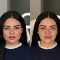 فیلرلب/ژل/نخ/کانتورینگ ۳/۵بوتاکس۳۹۰فیلربادی