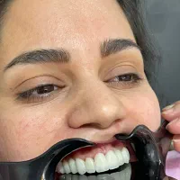 کاشت ایمپلنت کره ایی ۱۴/۵ توسط متخصص ایمپلنت