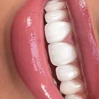 کامپوزیت لبه شیشه ای - زیبایی اقساطی