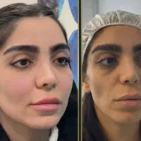 لیپو ساکشن شکم پهلو کمر و تزریق ب باسن