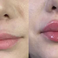 جشنواره ژل و بوتاکس