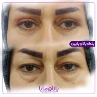با پلکهای اضافه خداحافظی کنید، بلفاروپلاستی