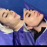 جشنواره جراحی زیبایی ساکشن غبغب.لیپوفیس.بلفارو