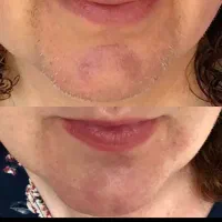 حذف دائمی موهای زائد سفید و سیاه با الکترولیز