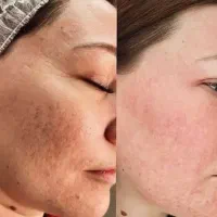 لیفت‌جوانسازی و روشنی وچربی سوزی
