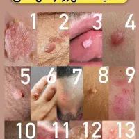 رفع ریشه ای زگیل تناسلی HPV
