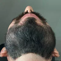 نمونه های واقعی / ببین چطور پرپشت شدن