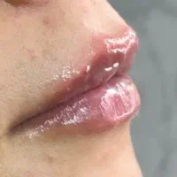 مدل جهت فیلر( ژل) لب زیر نظر پزشک