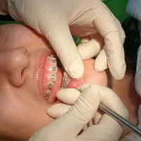 ارتودنسی فقط با ۱۳ تومن بدون چک و سفته