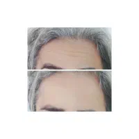 تخفیف ۵۰ درصدی بوتاکس