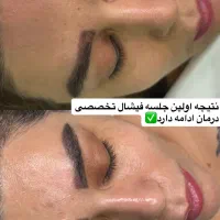 پاکسازی پوست وفیشال درمانی