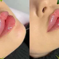آف تزریق ژل
