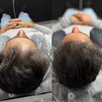 میکرو اسکالپ ، میکرواسکالپ (مرکز فوق تخصصی نارمک)