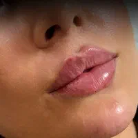 تزریق ژل و بوتاکس ژل لب، زاویه‌سازی