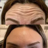 آموزش و تزریق ژل و بوتاکس