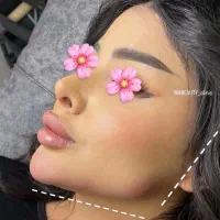 تزریق ژل و بوتاکس