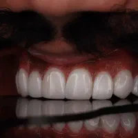 کامپوزیت/لمینیت/ایمپلنت/اقساط ویژه