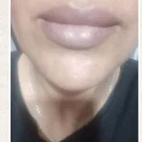 اموزش ژل بوتاکس فیلر مزو