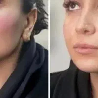 بایوفیلراتولوگ حجم دهی صددرصد طبیعی در مطب زیبایی