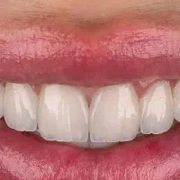 بهترین بیلیچینگ آلمانی همراه با ژل ضد حساسیت