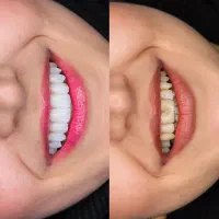 کامپوزیت ونیر طراحی لبخند طبیعی