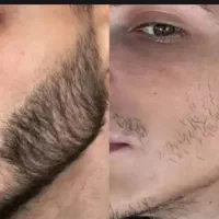کاشت انجام نده