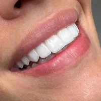 جشنواره دندانپزشکی کامپوزیت دندان عصبکشی و روکش