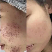 لایه برداری ، پاکسازی ،فیشال ، درمان جوش و جای جوش