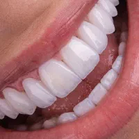 خدمات دندانپزشکی با قیمت استثنایی۳ روزه/کف قیمتی