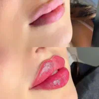 جشنواره بوتاکس نخ ابروزاویه ژل مادلینگ