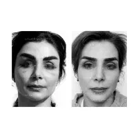 جشنواره تابستانی جراحی لیفت سینه صورت پیشانی
