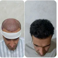 کاشت مو طبیعی تضمینی|خدمات آرایشگری و زیبایی|اصفهان, مرداویج|دیوار