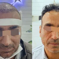 جشنواره کاشت مو