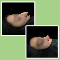 عمل زیبایی بینی یک روزه فقط ۴۵ تومن