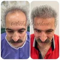 کاشت موی پرتراکم و کاشت ابروی طبیعی