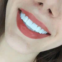 کامپوزیت دندان ((ویژه))